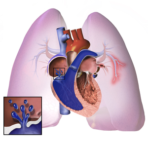 Tăng áp lực động mạch phổi là biến chứng bệnh phổi tắc nghẽn mạn tính thường gặp