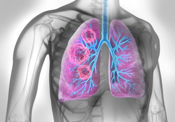 Ung thư phổi là hậu quả nghiêm trọng của nhiễm độc phổi
