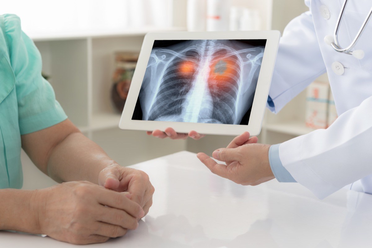Những nguyên nhân gây ung thư phổi mà bạn cần tránh