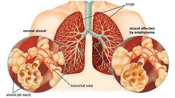 Bệnh phổi tắc nghẽn mãn tính giai đoạn cuối