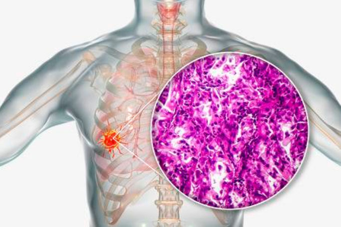 Các tế bào ở phổi tăng sinh mất kiểm soát hình thành các khối u trong phổi