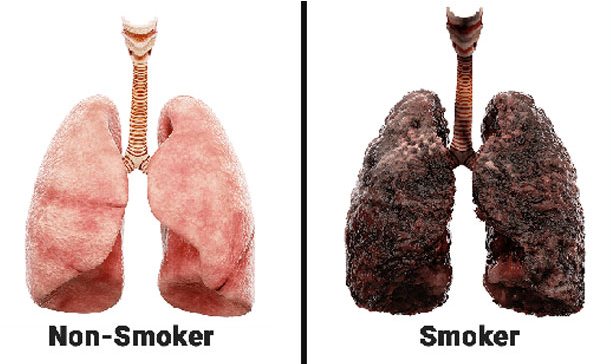 Khói thuốc là nguyên nhân hàng đầu gây ung thư phổi