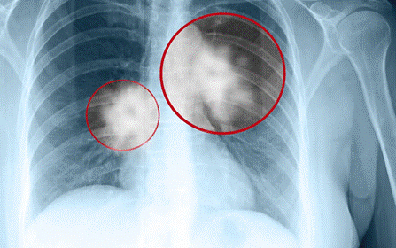 Chụp X quang ung thư phổi