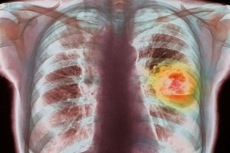 Người đã bỏ thuốc lá vẫn phải đối mặt với nguy cơ ung thư phổi do phổi đã bị nhiễm độc từ trước