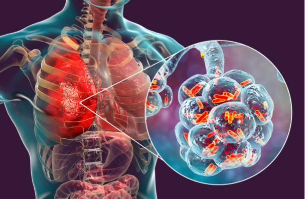 Viêm phổi có nguyên nhân do phổi bị nhiễm độc bởi các vi sinh vật
