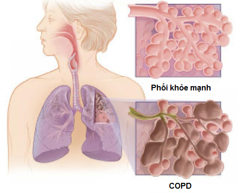 COPD là bệnh gì?
