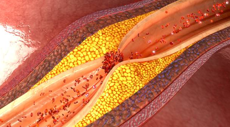 Rối loạn mỡ máu gây xơ vữa mạch máu ở bệnh nhân tiểu đường
