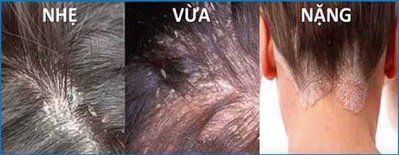Bệnh nấm da đầu có thể gây rụng tóc
