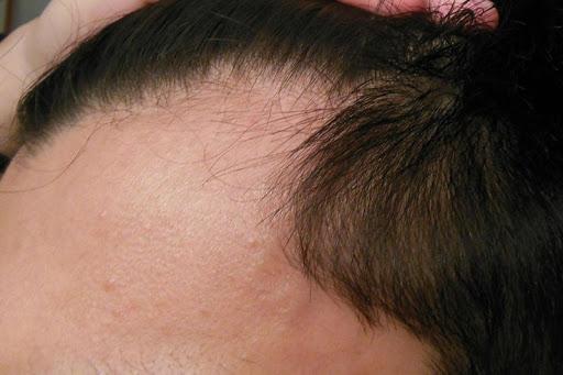 Tình trạng chân tóc yếu dẫn tới tóc gãy rụng