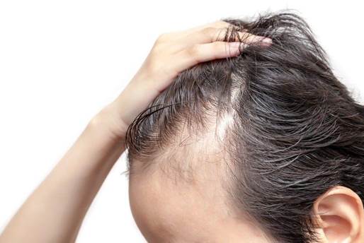 Rụng tóc di truyền có chữa được không, có gây hói đầu không?
