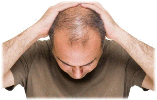 Tình trạng hói đầu có khắc phục được không? 