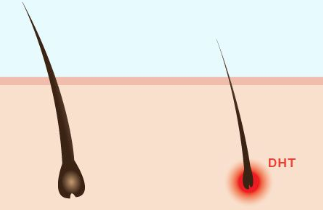 DHT khiến tóc bị rụng hoặc chậm phát triển