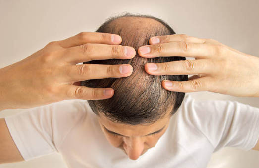 Nguyên nhân gây hói đầu ở nam giới là gì? Có cách nào điều trị không?