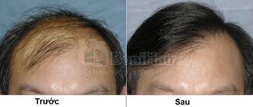 Mái tóc chú Thiết trước và sau khi sử dụng BoniHair