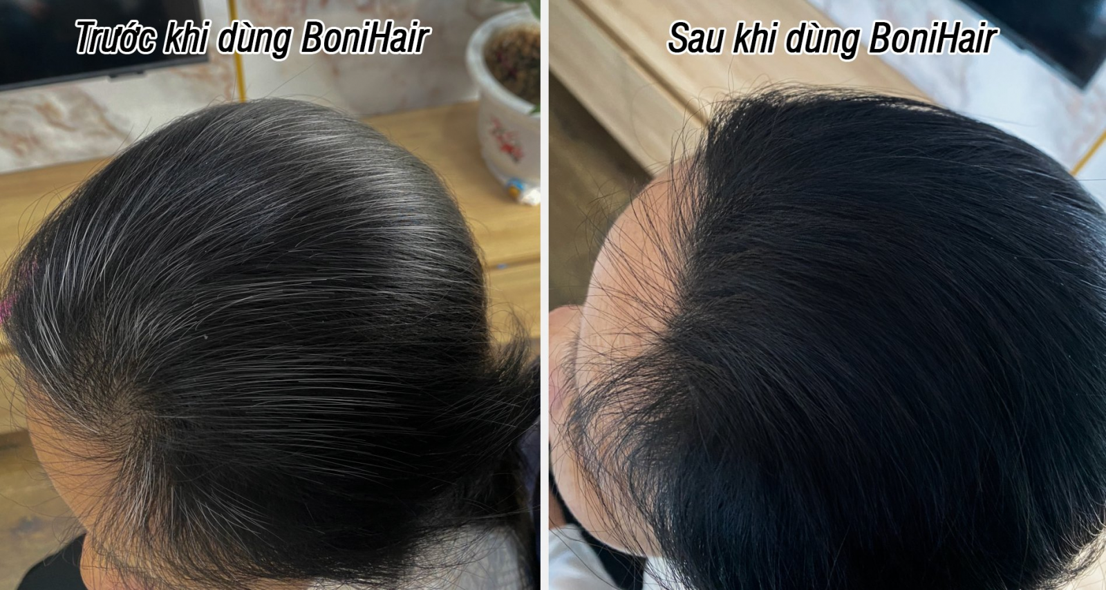 Mái tóc của cô Nga trước và sau khi sử dụng BoniHair