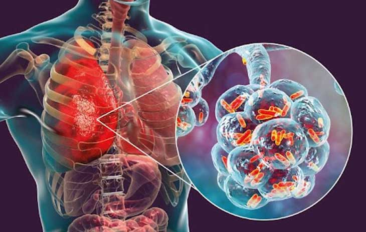 Adenovirus có thể xâm nhập vào phổi gây viêm phổi