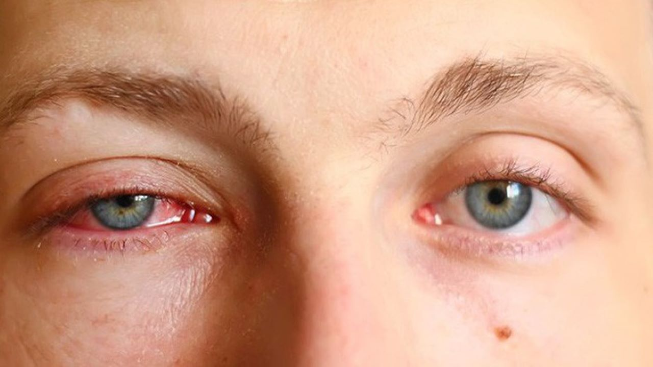 Khi nhiễm Adenovirus, trẻ nhỏ có thể bị viêm kết mạc mắt