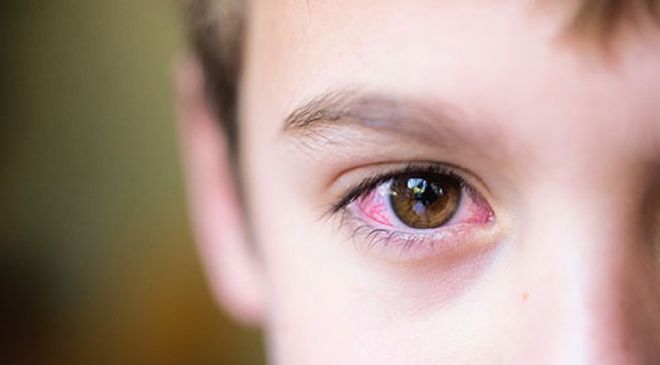 Tìm hiểu về bệnh khô mắt ở trẻ do thiếu vitamin