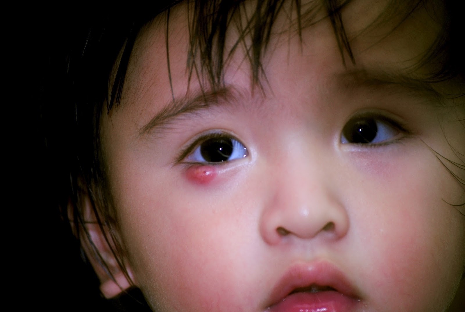 Tìm hiểu về bệnh chắp mắt ở trẻ em