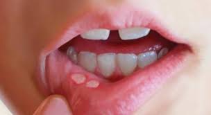 Tìm hiểu về viêm loét miệng ở trẻ em