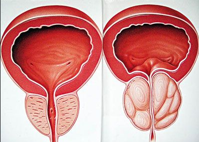 Phì đại tuyến tiền liệt (bên phải) gây bí tiểu ở nam giới ngoài 40 tuổi trở lên