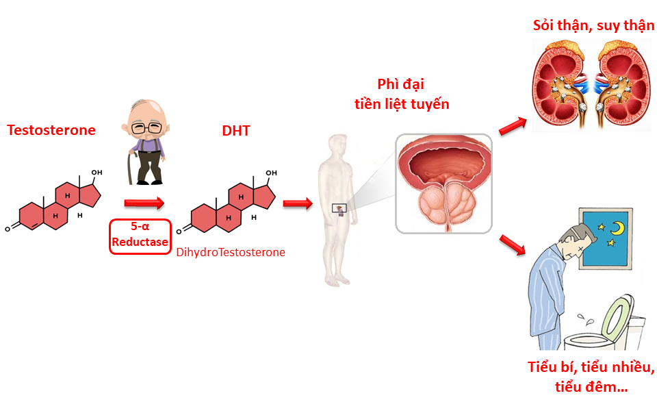 Sự tăng nồng độ DHT là nguyên nhân gốc gây bệnh phì đại tuyến tiền liệt