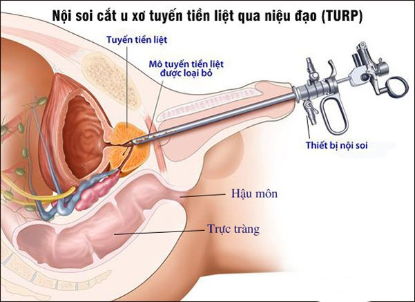 Phương pháp phẫu thuật nội soi qua ống niệu đạo