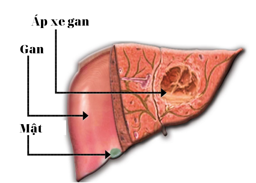 Áp-xe gan là biến chứng thường gặp của bệnh viêm đại tràng amip