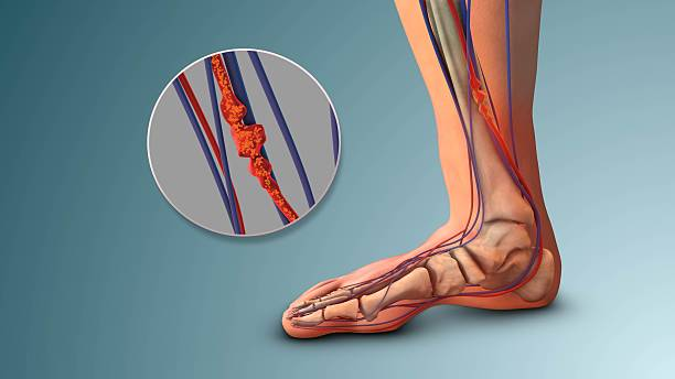 Gout không dừng ở khớp: Nghiên cứu cảnh báo nguy cơ huyết khối tĩnh mạch