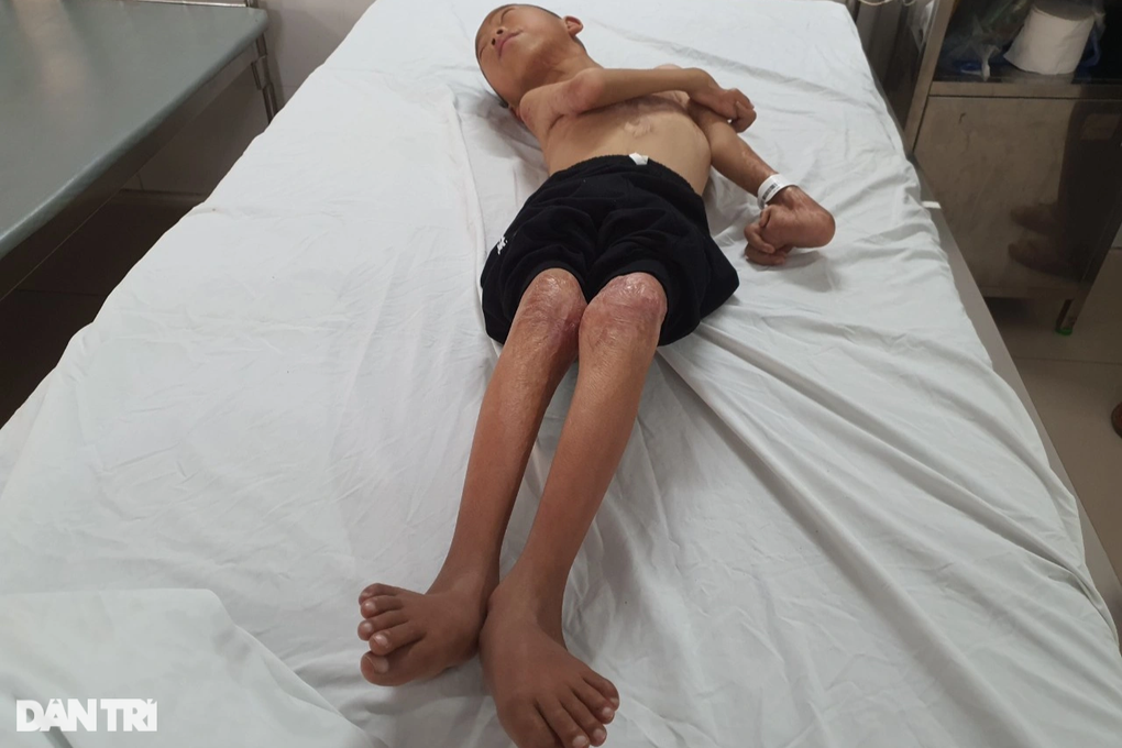 Công ty Botania nghẹn ngào trước cậu bé bị biến dạng cơ thể vì bỏng
