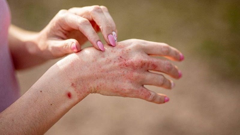 Sai lầm khiến bệnh da liễu nặng hơn sau đợt mưa lũ