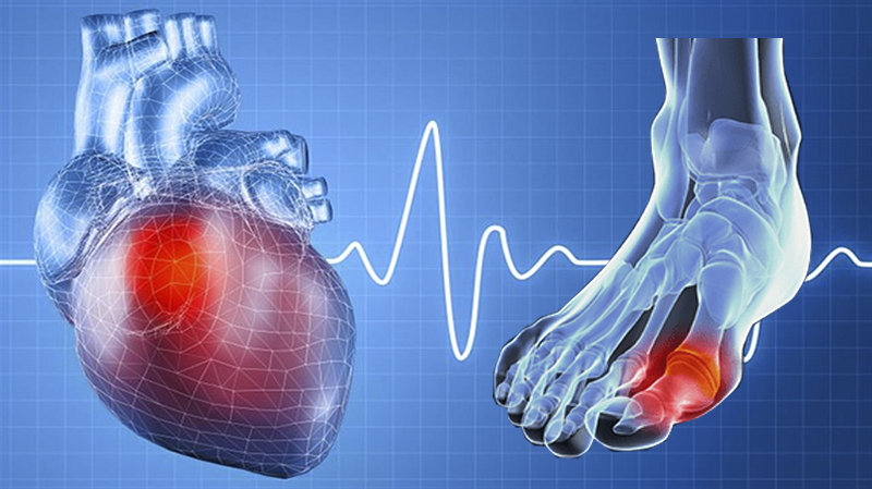 Mối liên quan giữa bệnh Gút và các bệnh lý tim mạch
