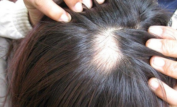 Hỏi: 55 tuổi, rụng tóc gần như hói ở vùng trán, có dùng được BoniHair hay không?