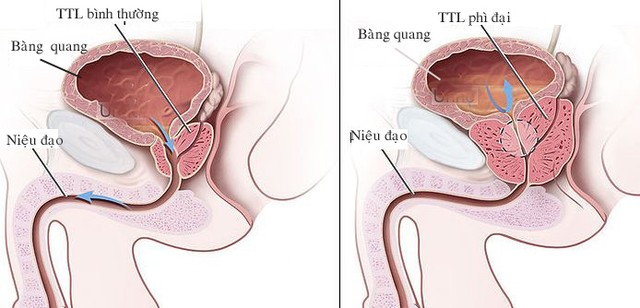 Hỏi: Dùng BoniMen có khỏi được bệnh phì đại tuyến tiền liệt hay không?